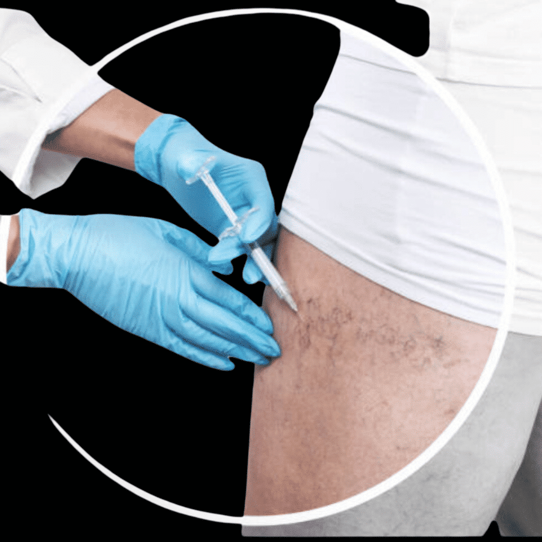 micro-sclerotherapy