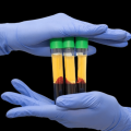 PRP Platelet Rich Plasma