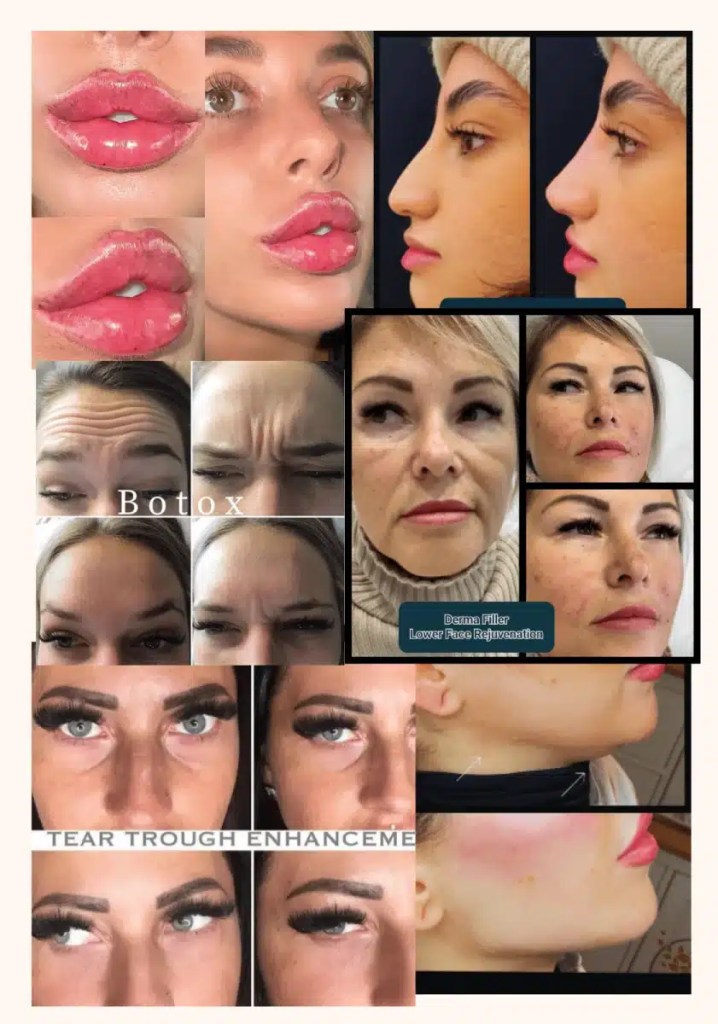 Dermal Fillers