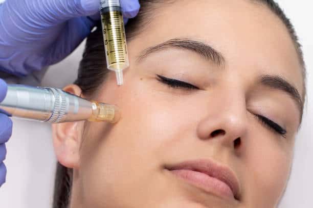 prp-microneedling