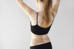 White Vitiligo Spots