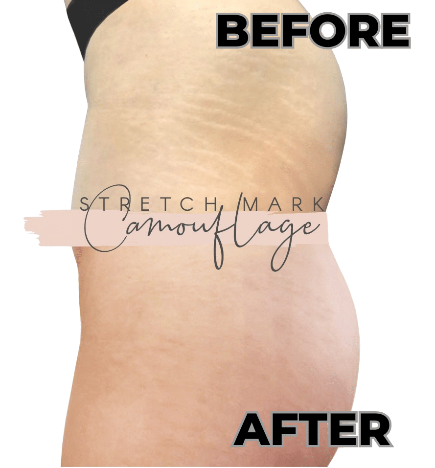 INKLESS STRETCH MARKS REMOVAL