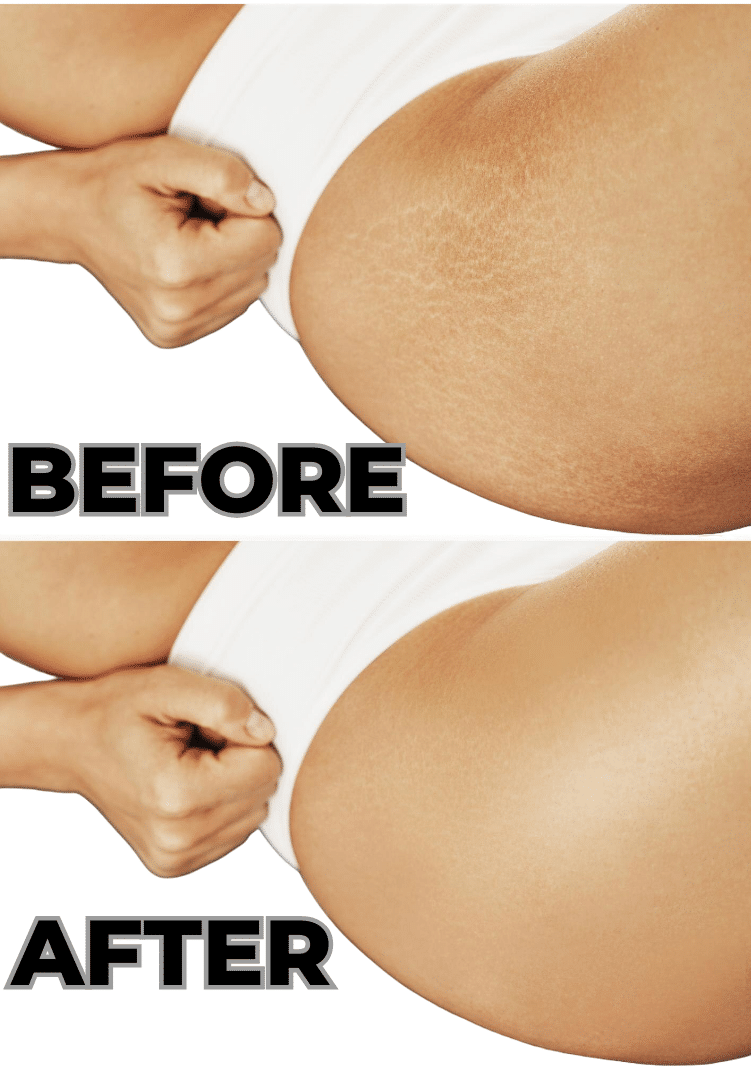 Inkless Stretch Marks Before & After