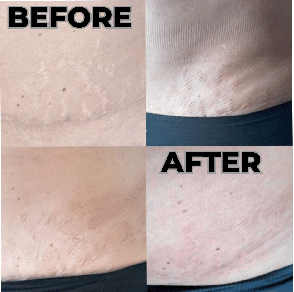 STRETCH MARKS REMOVAL