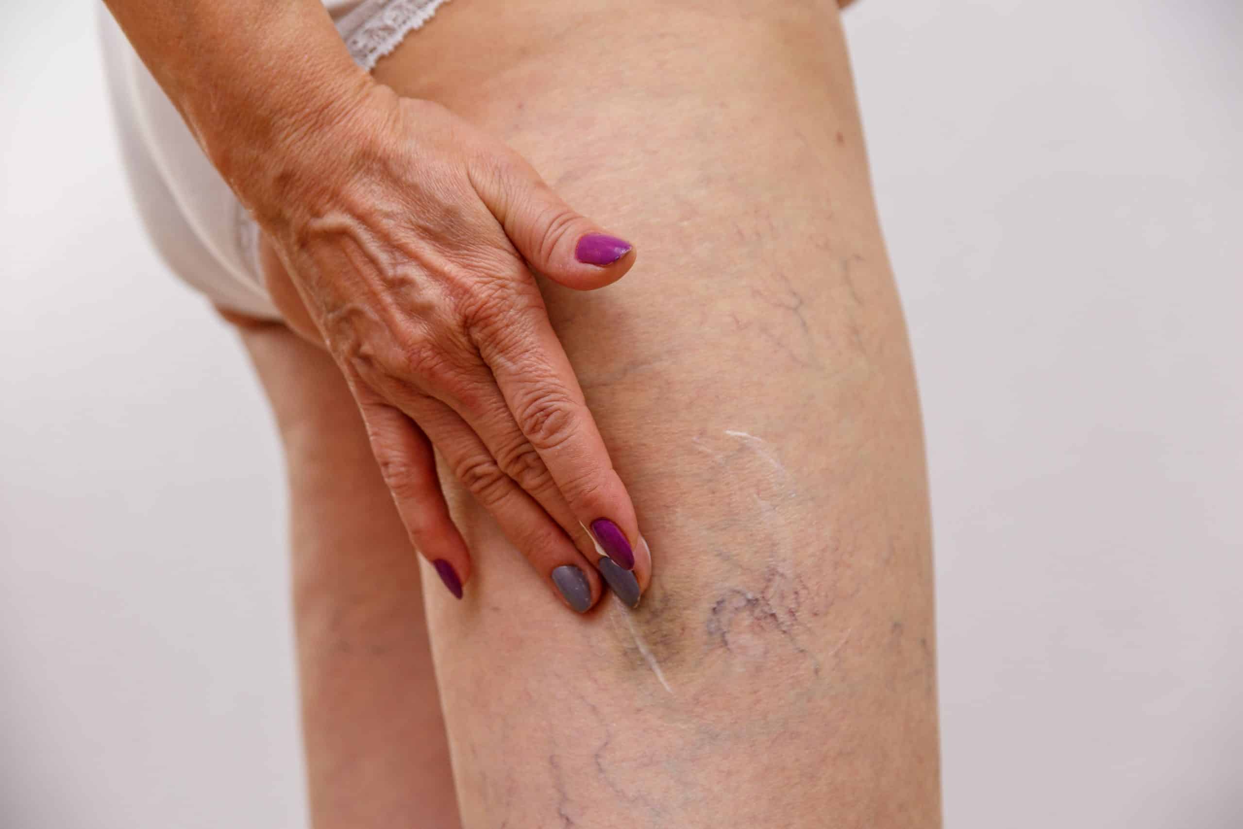 Sclerotherapy on the legs