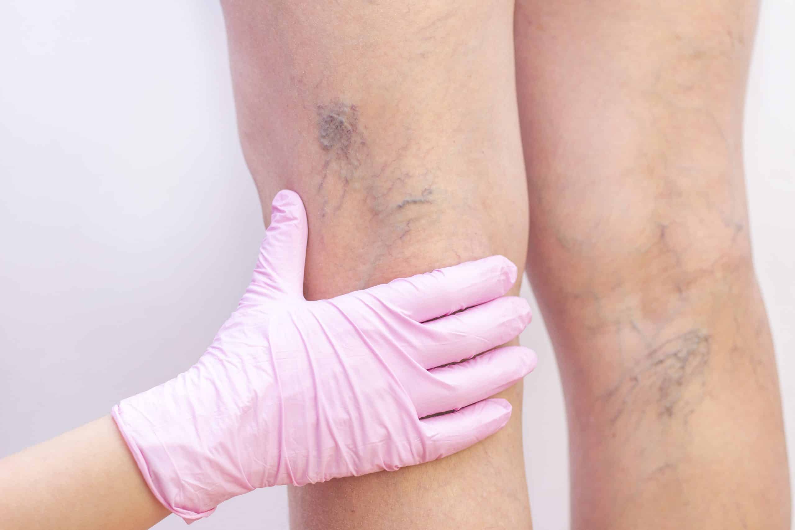 Spider veins injection