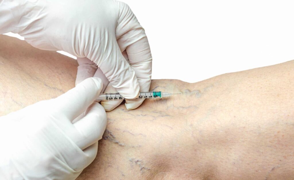 sclerotherapy legs with injection