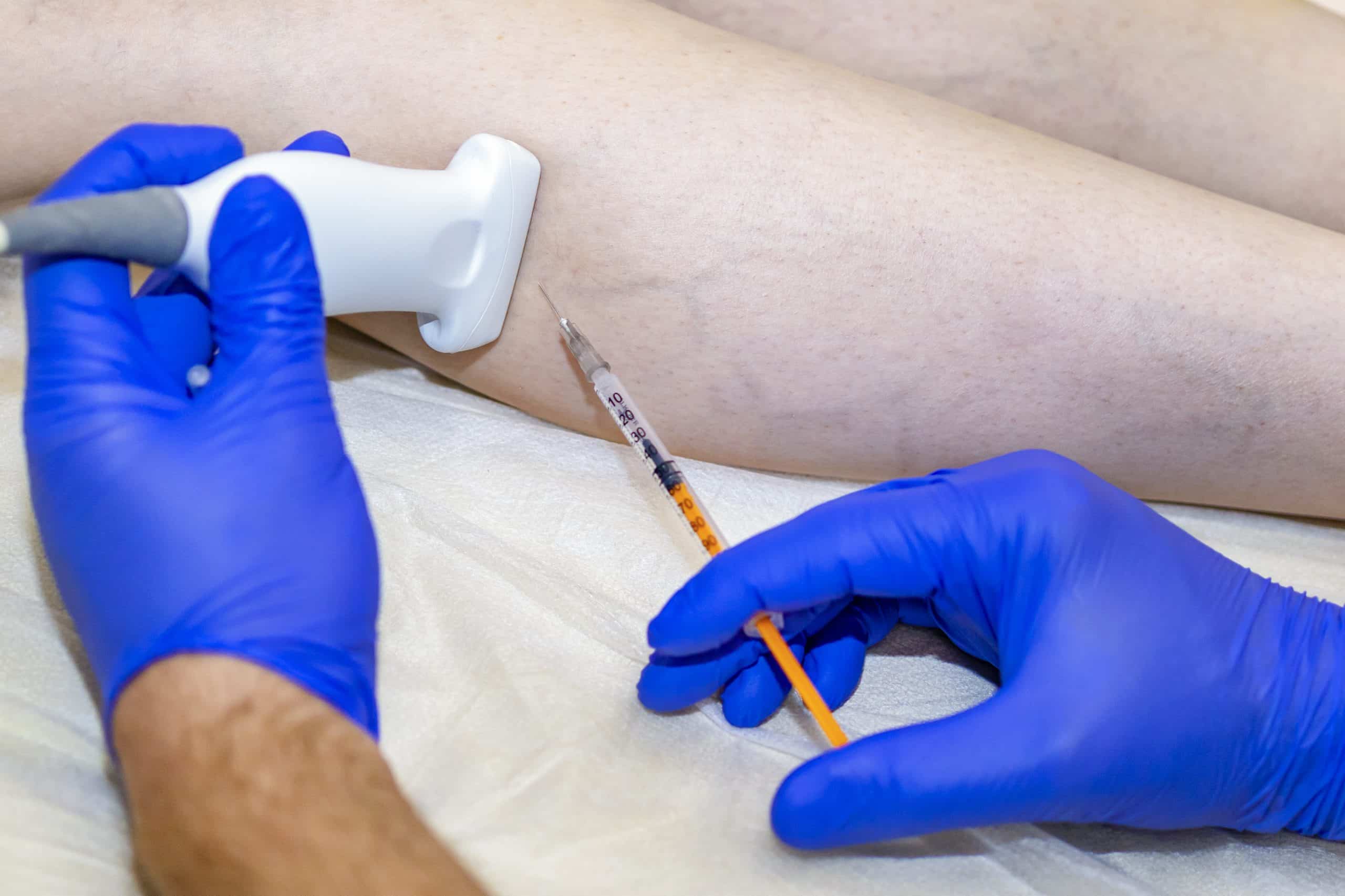 Varicose veins injection on the leg
