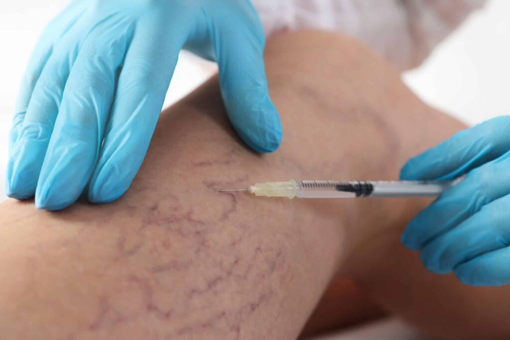 Thread veins Injection
