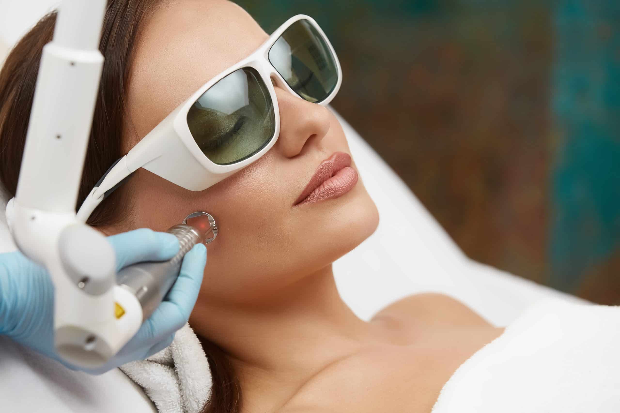 fractional CO2 laser treatment