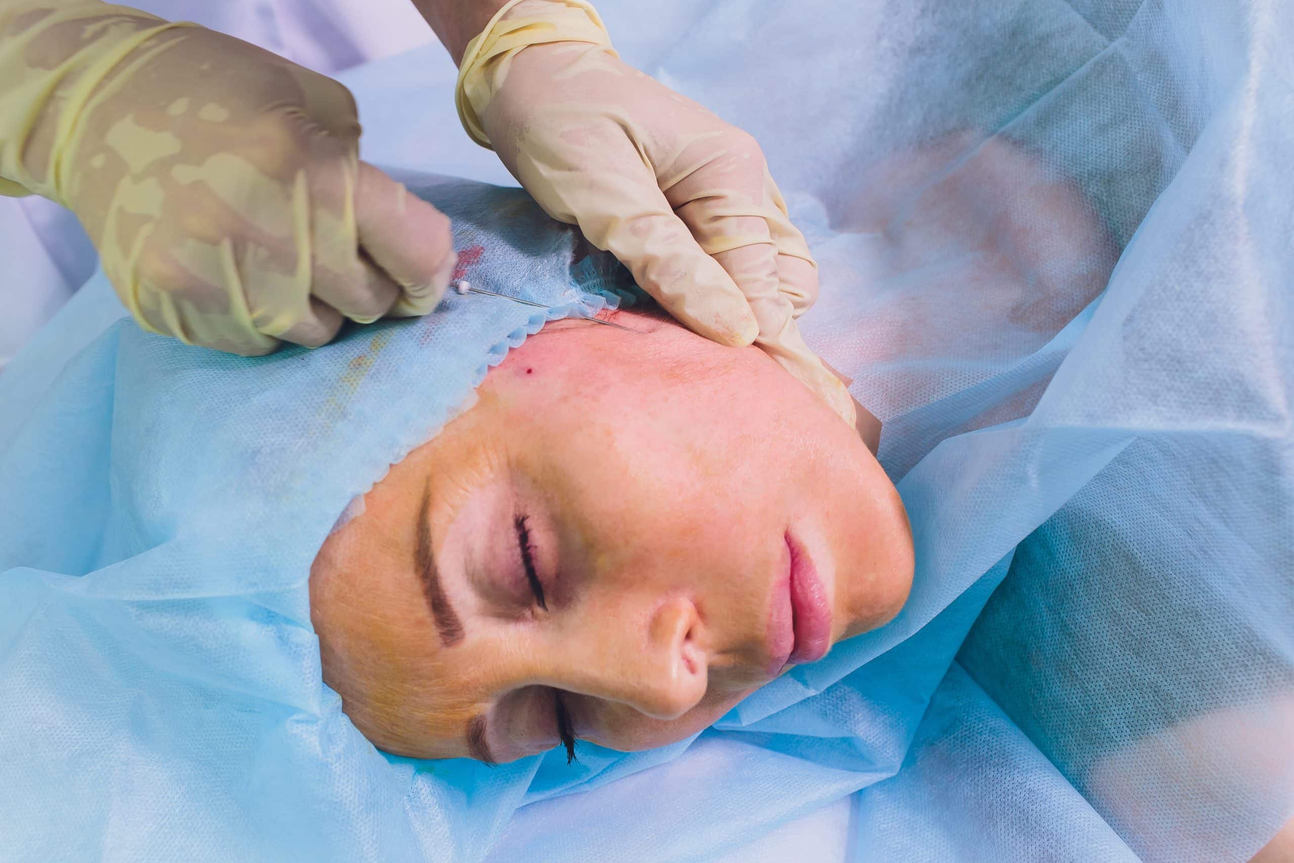 Price Of PDO Thread Lift