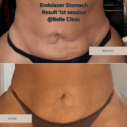 endolaser stomach before and after