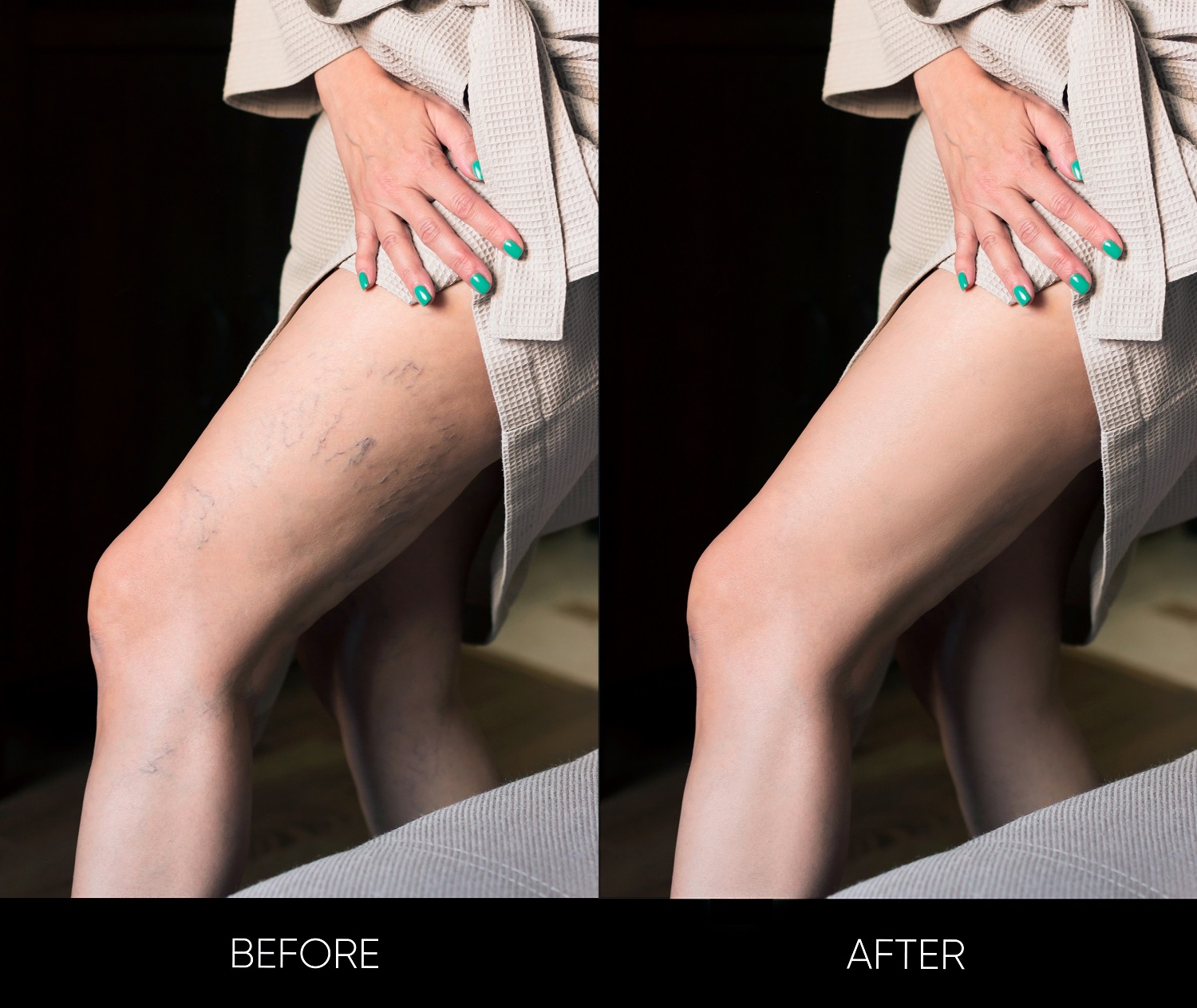 Leg vein removal