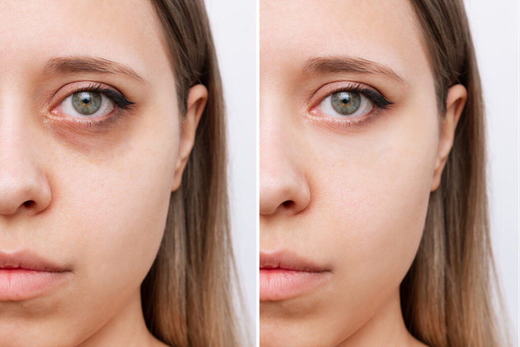 Tear Trough & Midface (Apple Cheeks) treatment technique taught on the course