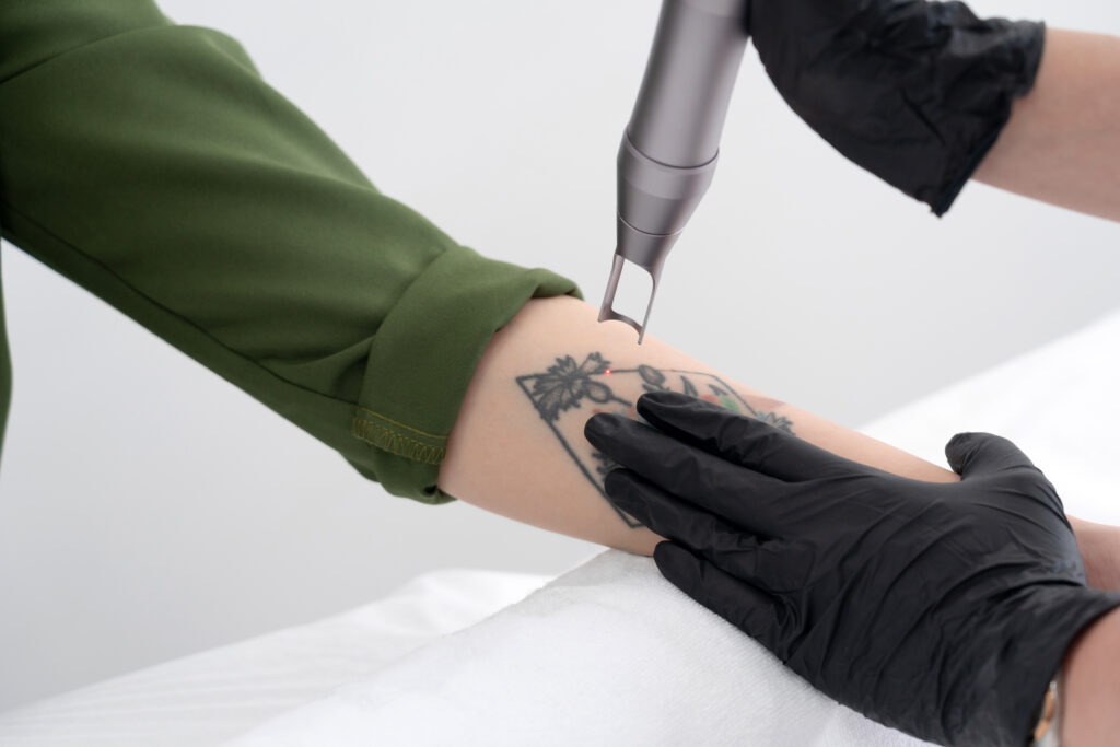 Laser Tattoo Removal treatment technique taught on the course