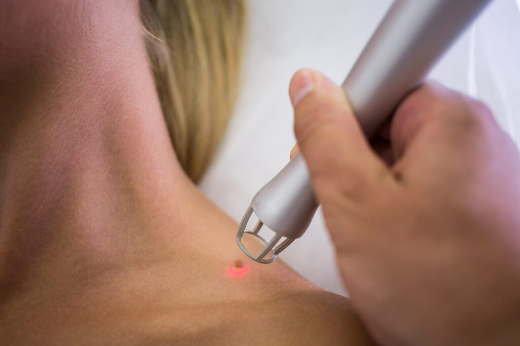 CO₂ Fractional Laser Resurfacing treatment technique taught on the course