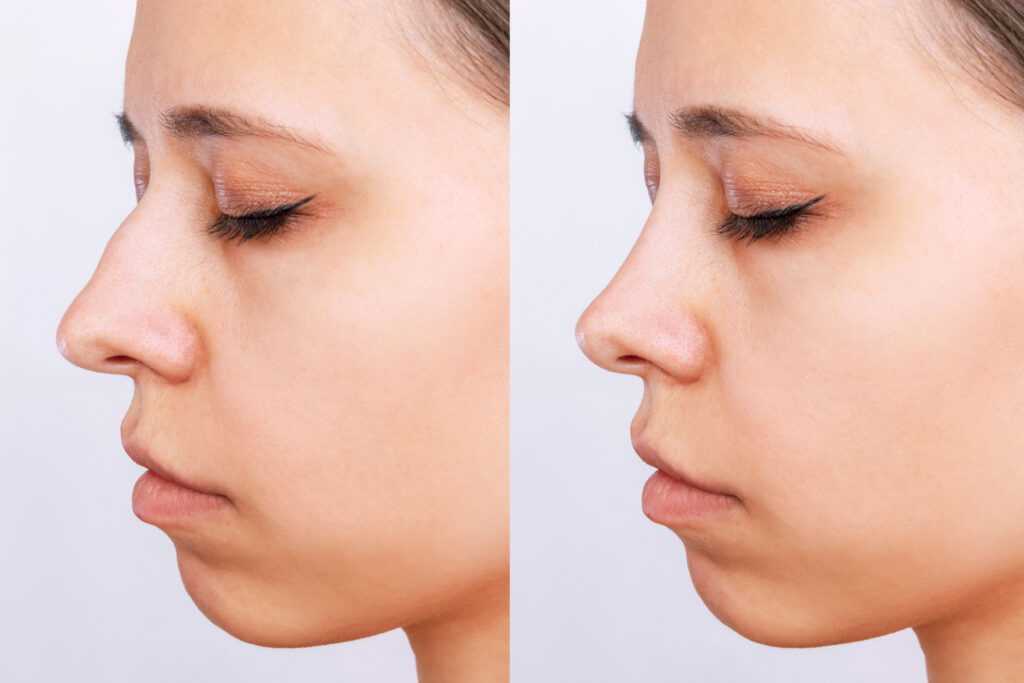 Facial Profile Balancing (Profiloplasty) treatment technique taught on the course