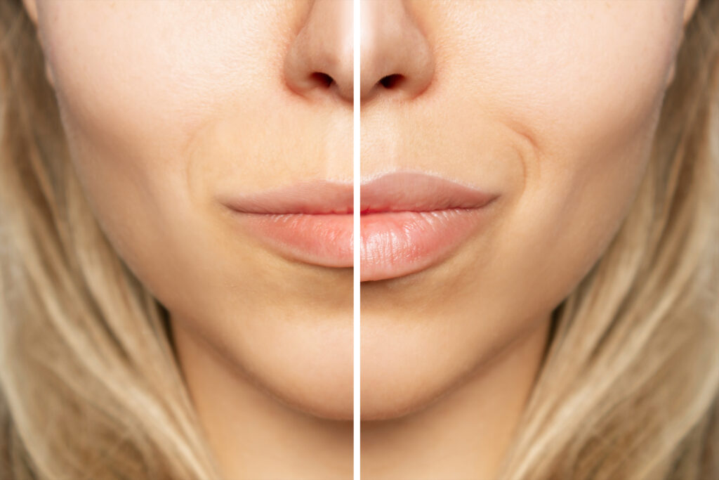 Russian Lip treatment technique taught on the course