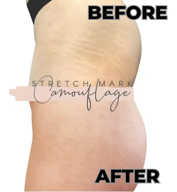 INKLESS-STRETCH-MARKS-REMOVAL-1.png